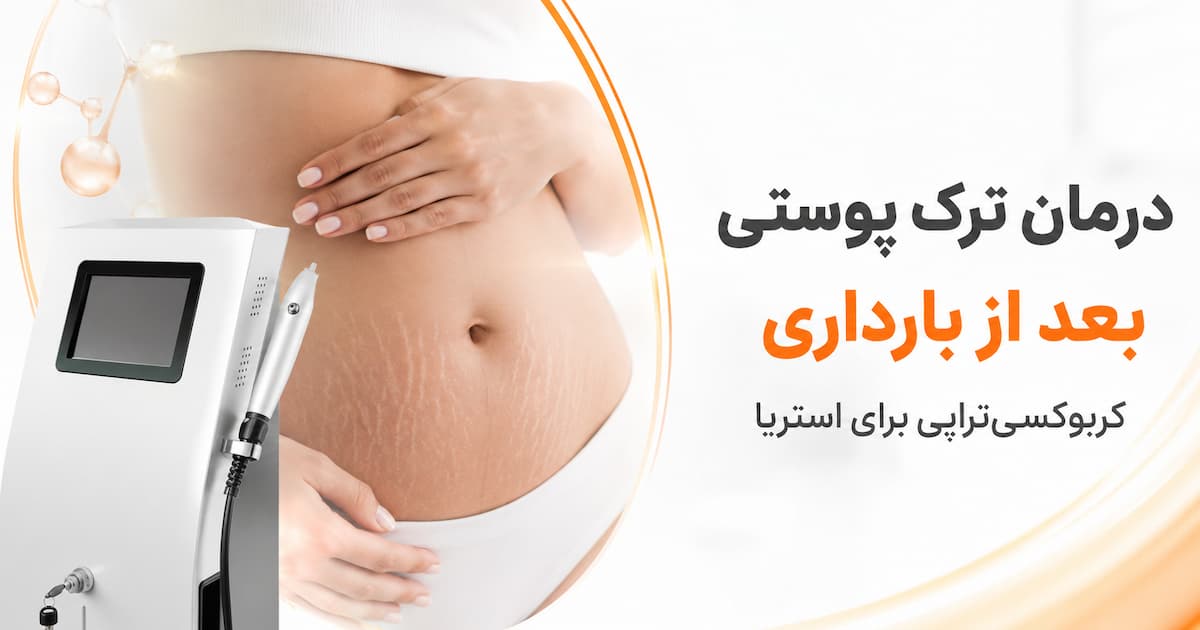 درمان ترک پوستی بعد از بارداری