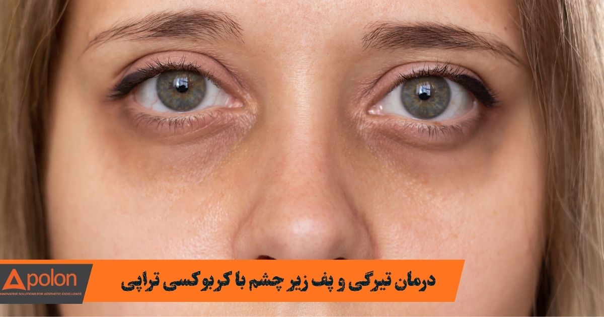 درمان تیرگی زیر چشم