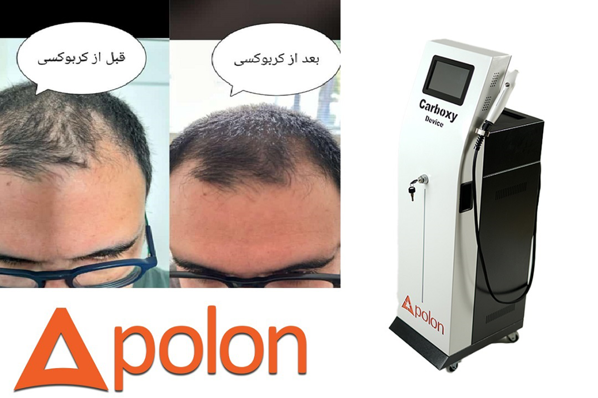دستگاه کربوکسی تراپی مو چیست؟